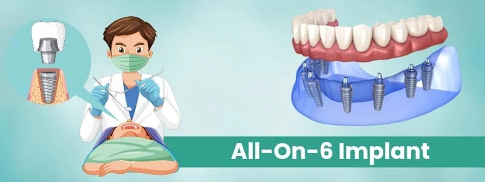 all-on-6 implant cost in india