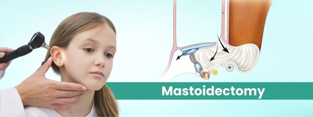 mastoidectomy cost in india