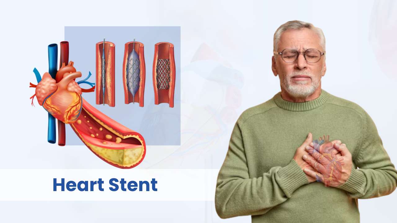 heart stent