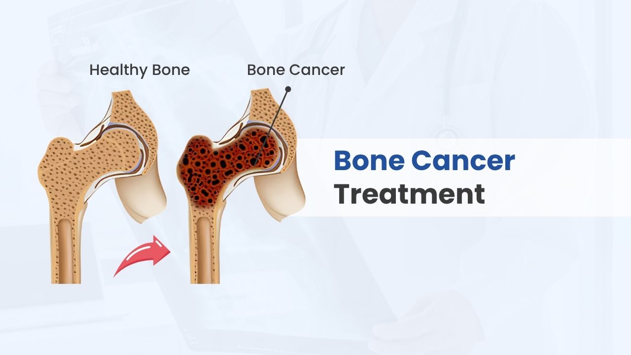 bone cancer treatment cost in india