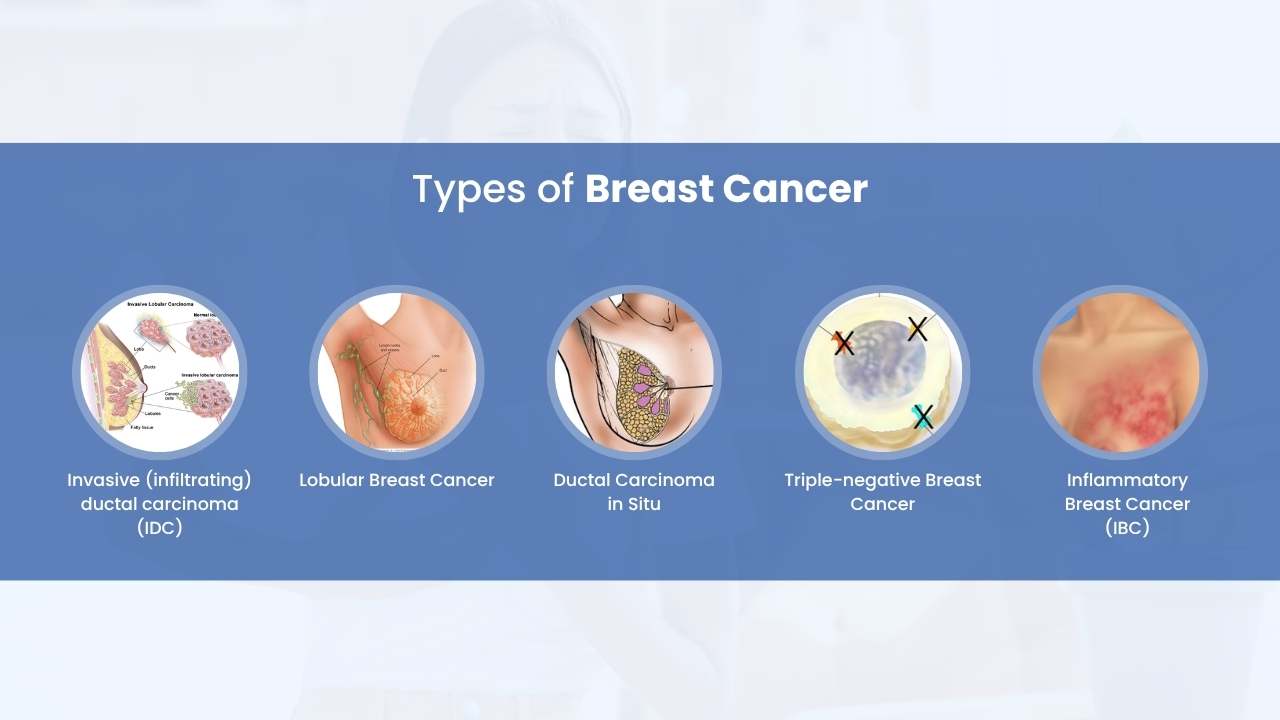 what re the types of breast cancer