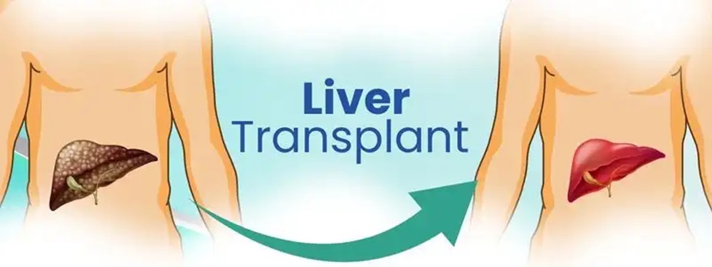 liver transplant surgery cost in india