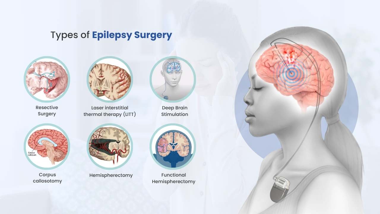what are the type of epilepsy surgery