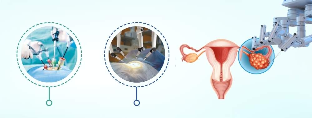 technologies used in india for ovarian cyst removal