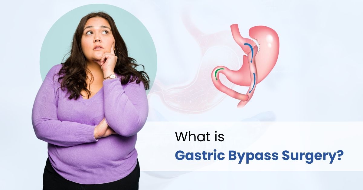 Understanding Gastric Bypass Surgery | A Complete Guide to Weight Loss ...