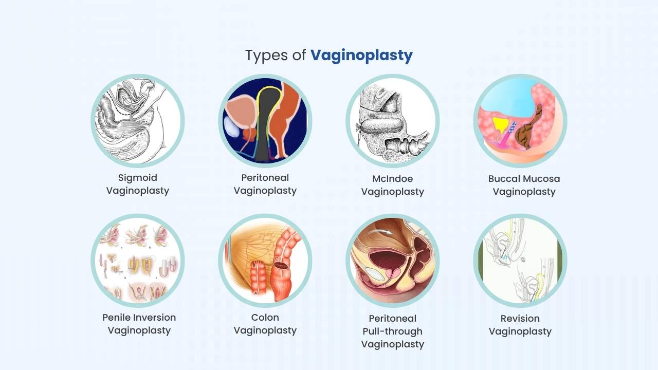 what are the types of vaginoplasty