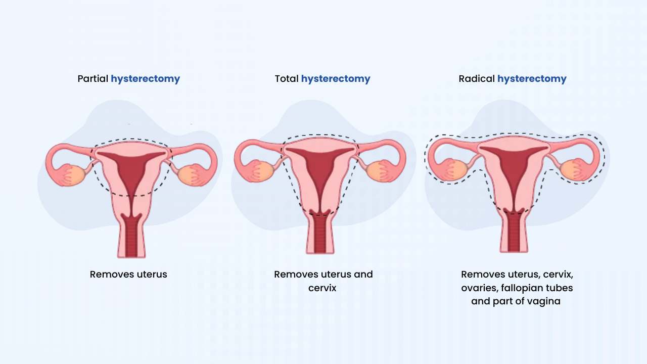what are the types of hysterectomy 