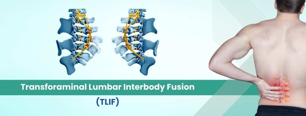 transforaminal lumbar interbody fusion (tlif) cost in india