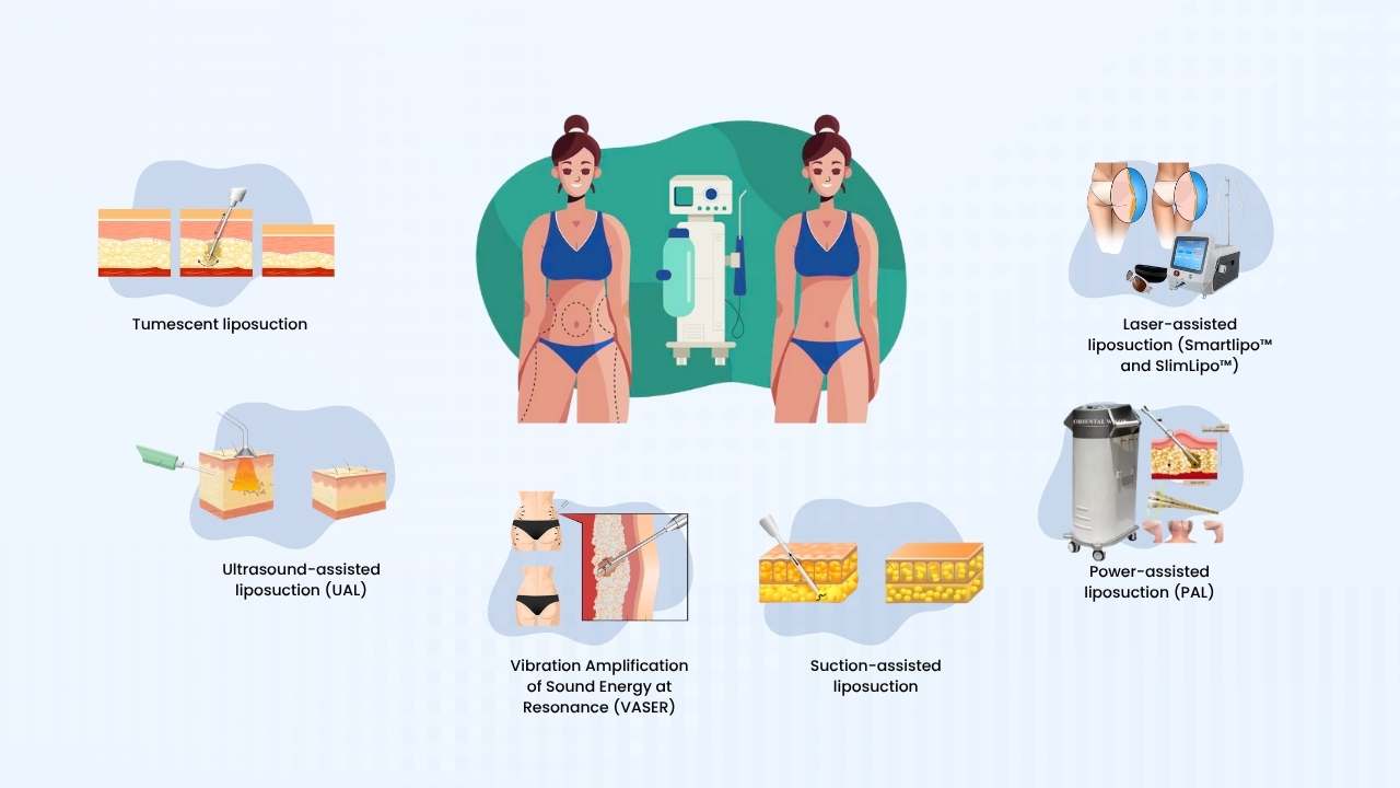 what are the types of liposuction surgeries