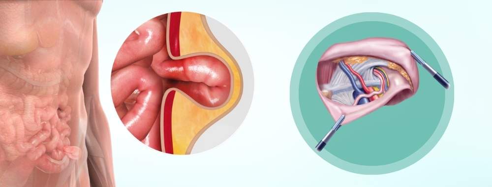 technology used in hernia repair surgery in india