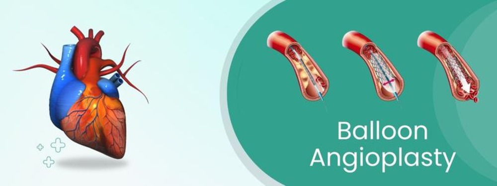 balloon angioplasty cost in india