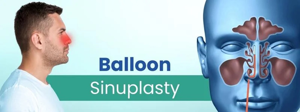 balloon sinuplasty cost in india