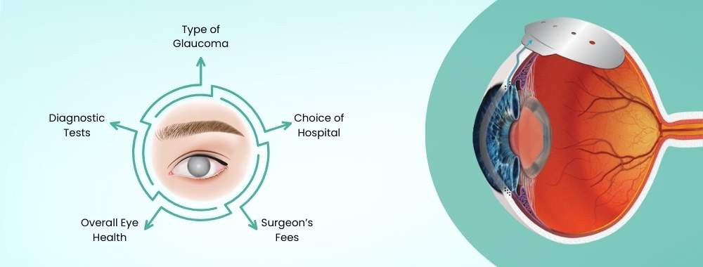 factors affecting the cost of glaucoma surgery in india