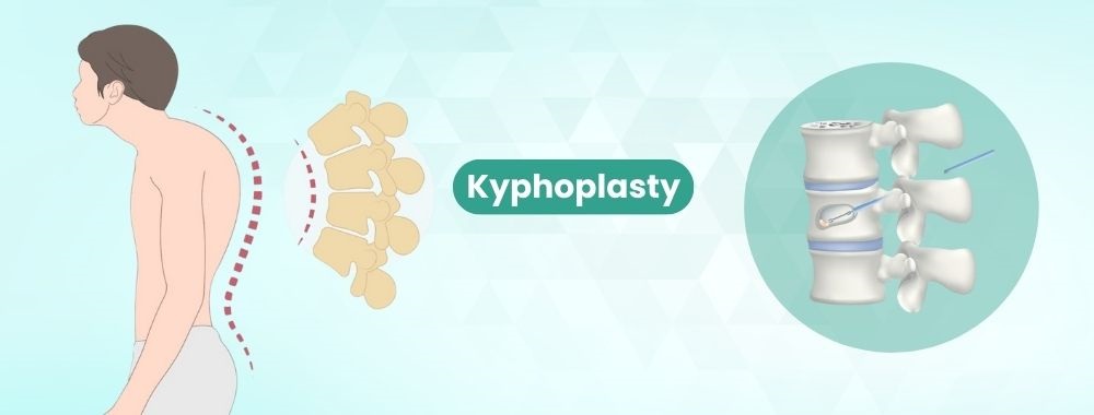 kyphoplasty surgery cost in india