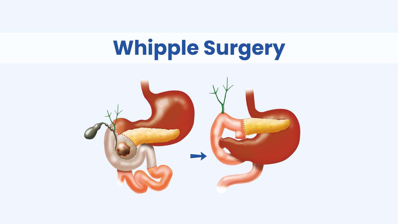 whipple surgery cost in india