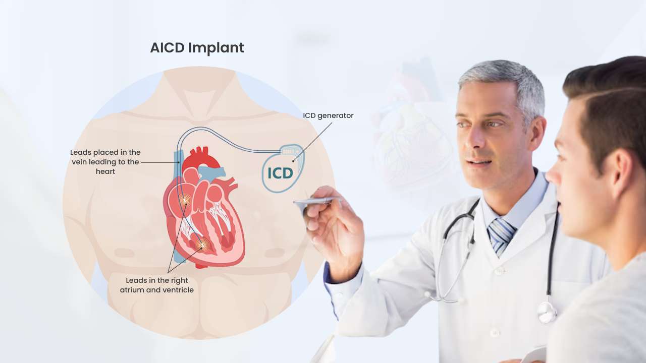 what is AICD implant