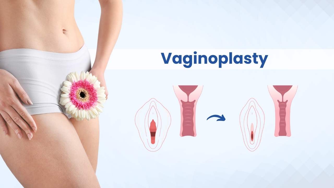 vagionoplasty