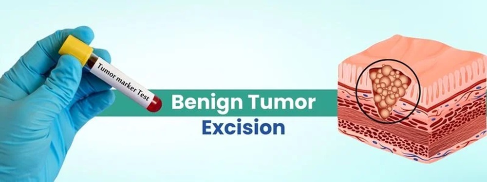 benign tumor excision cost in india