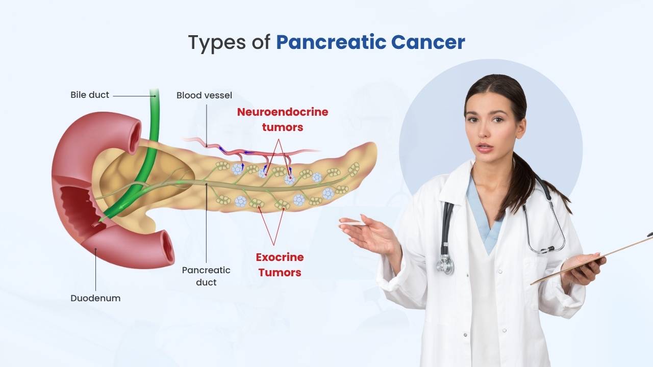 types of pancreatic cancer treatment