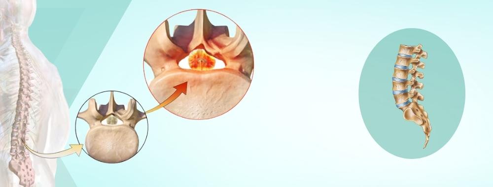 factors affecting the cost of spine decompression surgery