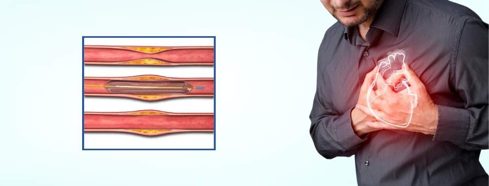 technologies used in india for balloon angioplasty
