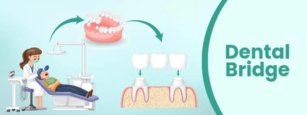 dental bridge cost in india