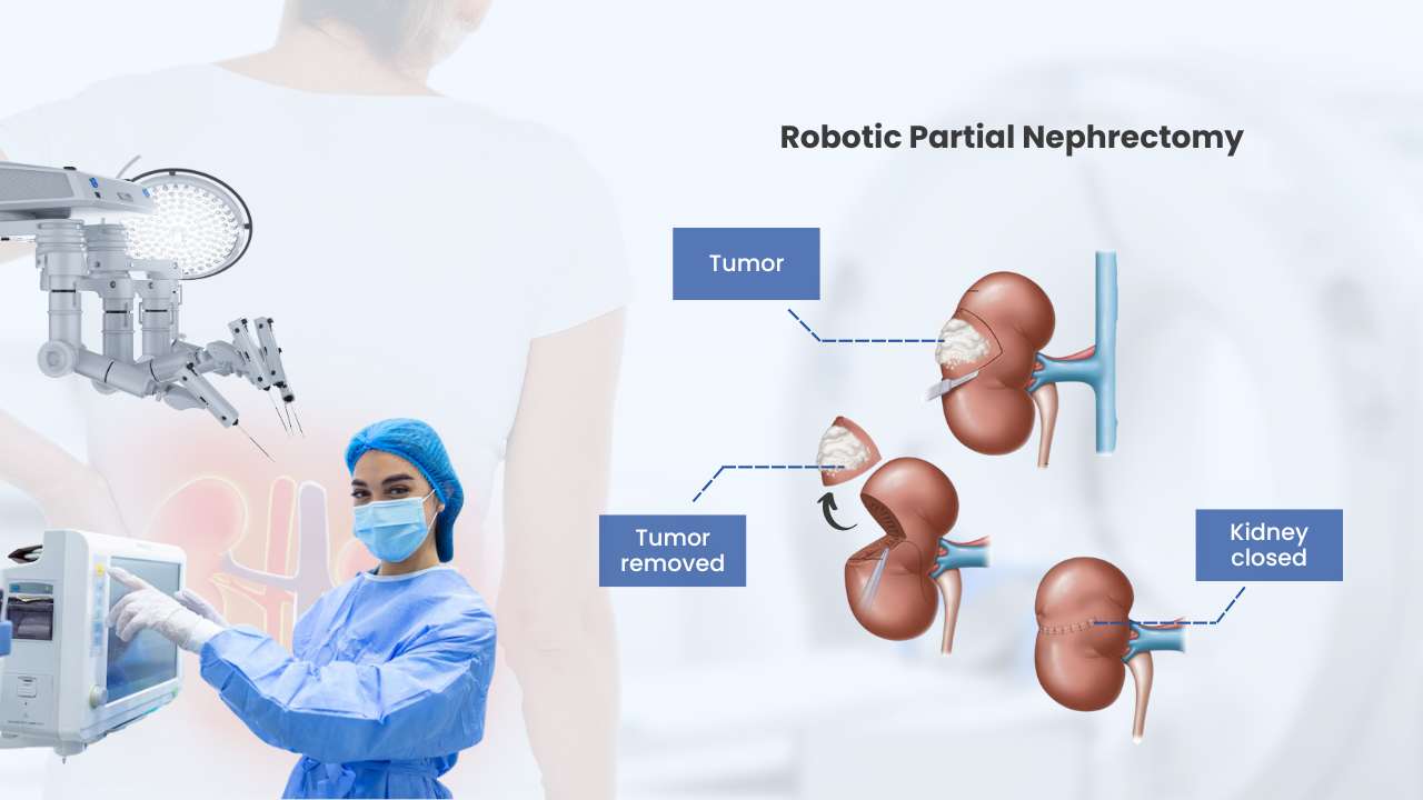 robotic partial nephrectomy 