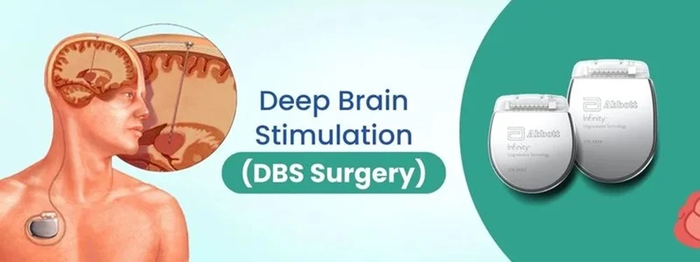 deep brain stimulation (dbs surgery) cost in india