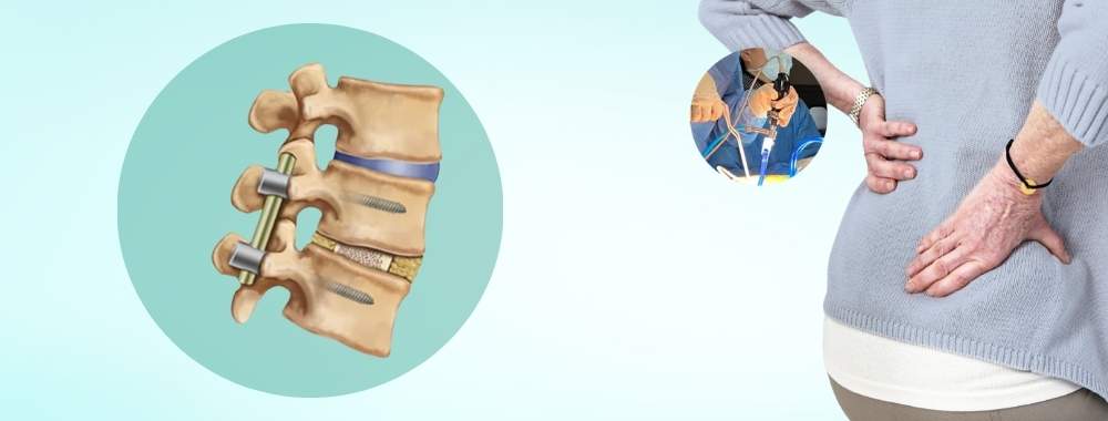 factors affecting the cost of transforaminal lumbar interbody fusion (tlif)