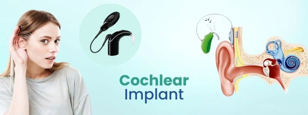cochlear implant
