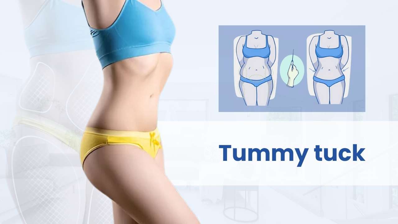 Tummy tuck