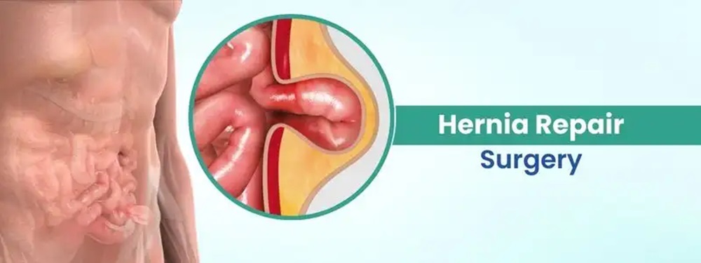 hernia repair surgery cost in india