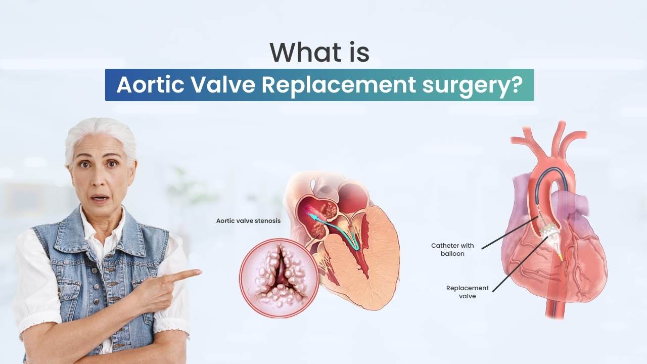 Aortic Valve Replacement Surgery Rate
