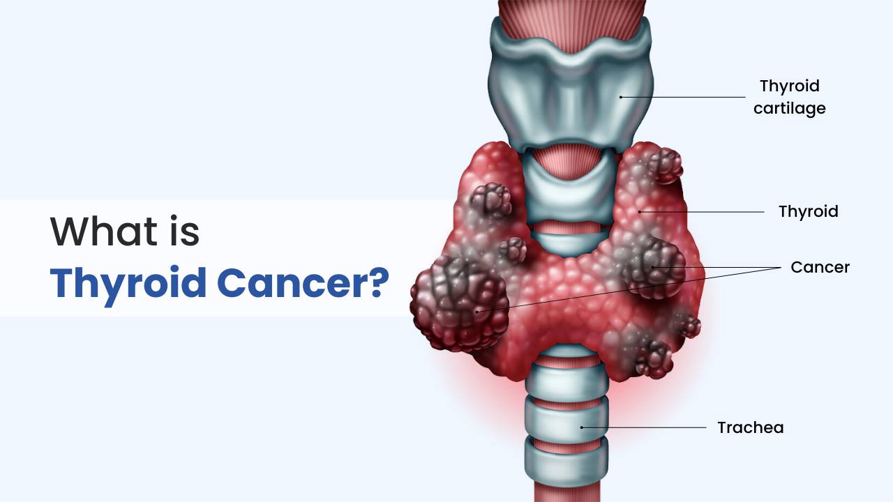 Top 10 Thyroid Cancer Symptoms You Shouldn't Ignore