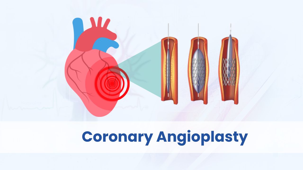 coronary angioplasty cost in india