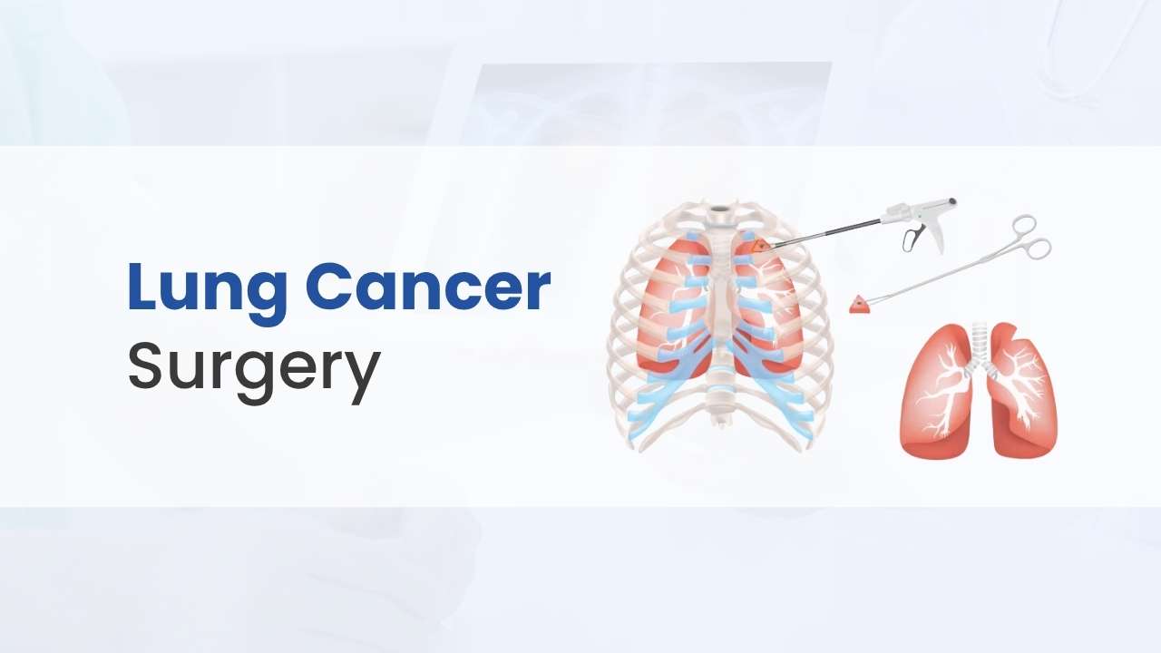 lung cancer surgery cost in india