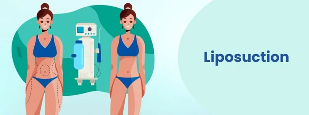 liposuction surgery cost in india