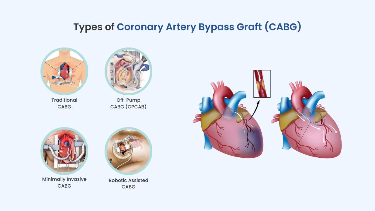 types of cabg