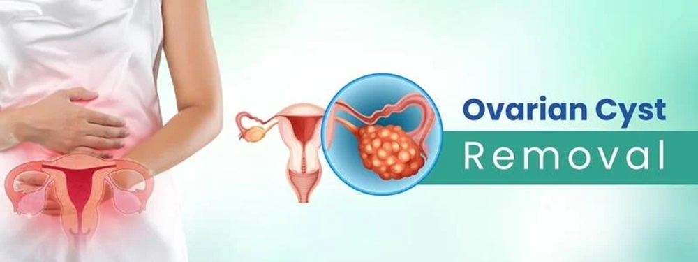 ovarian cyst removal cost in india