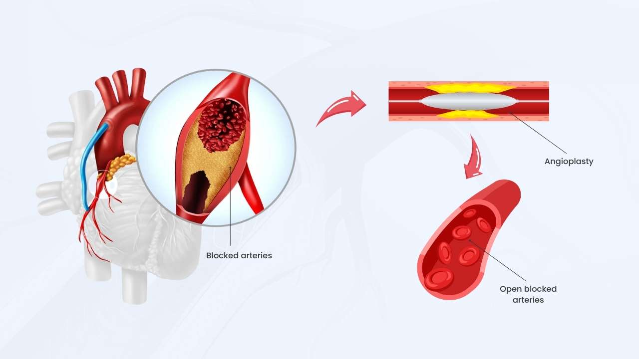 who need a coronary angioplasty