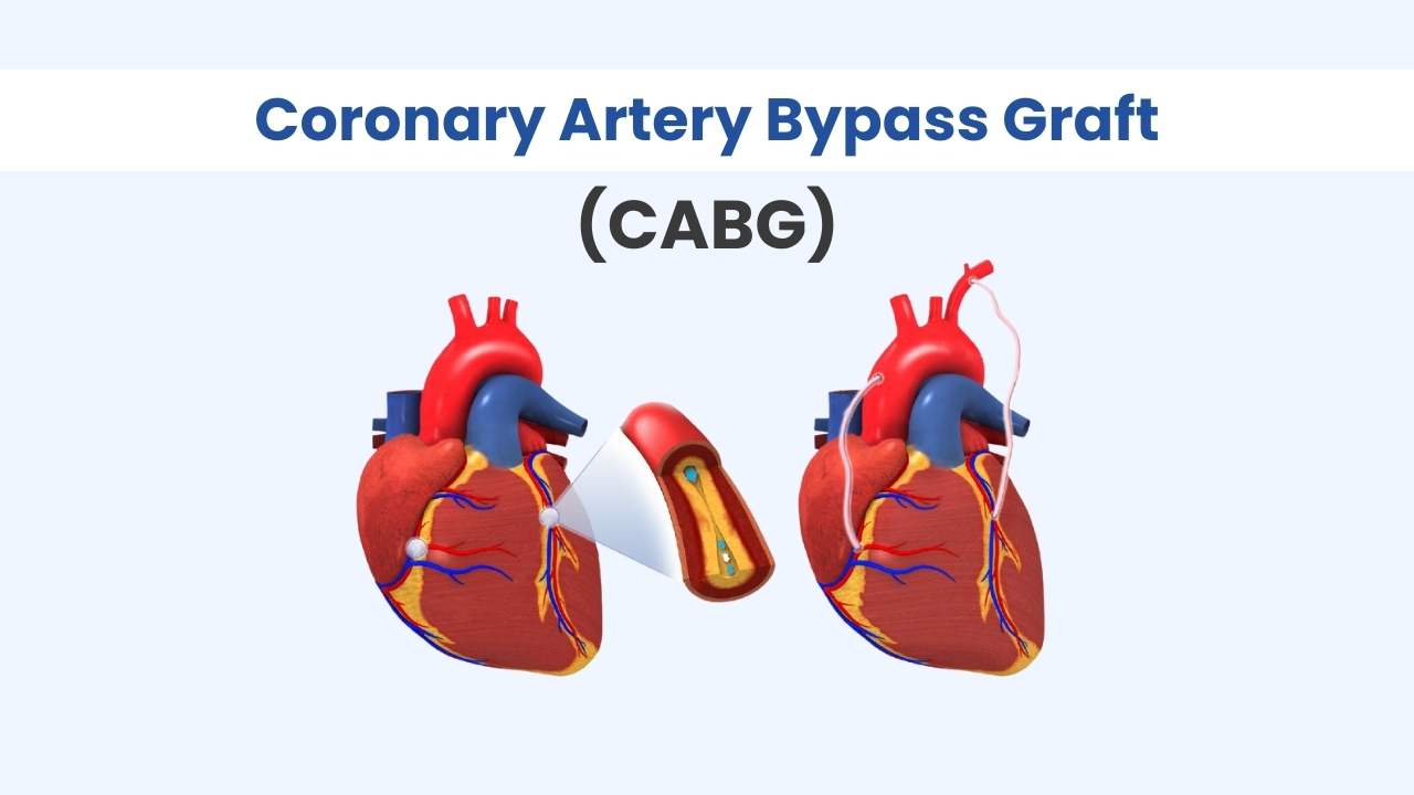 coronary artery bypass graft