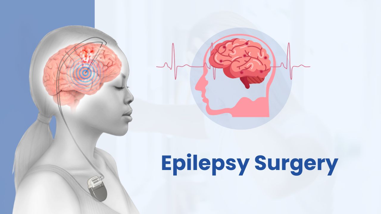 epilepsy surgery
