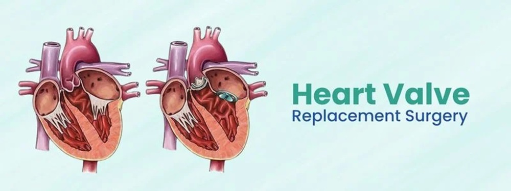 heart valve replacement surgery cost in india