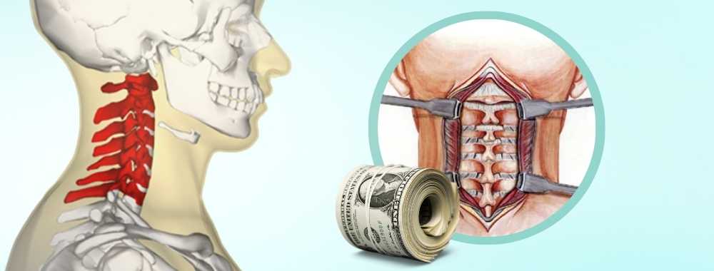factors affecting the cost of cervical spine surgery