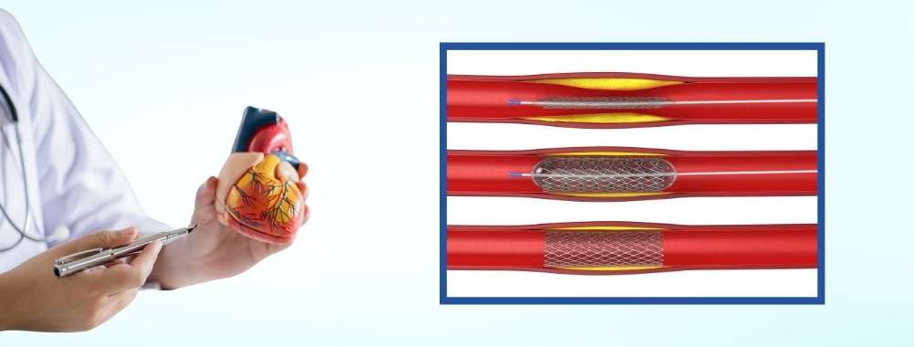 complications after balloon angioplasty