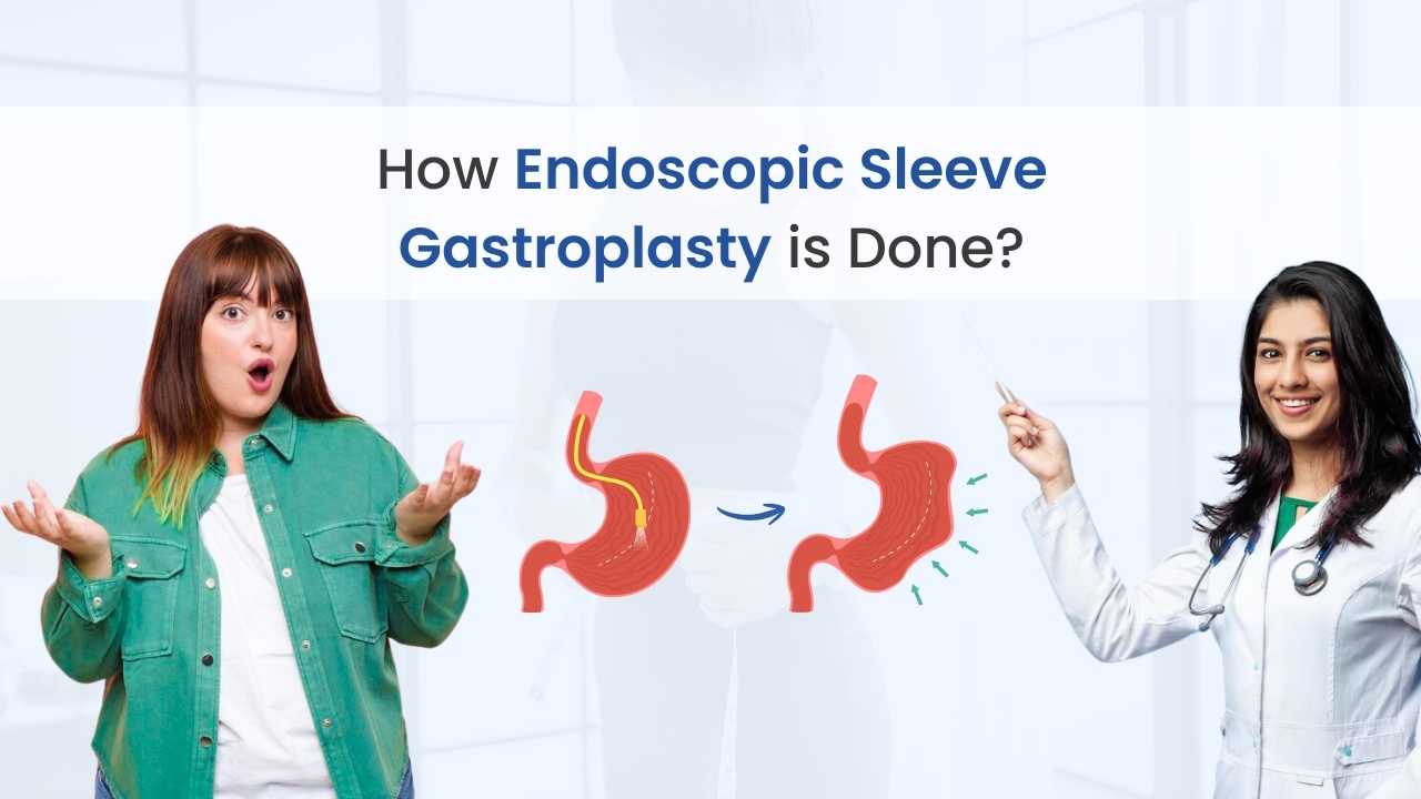 how endoscopic sleeve gastroplasty is done
