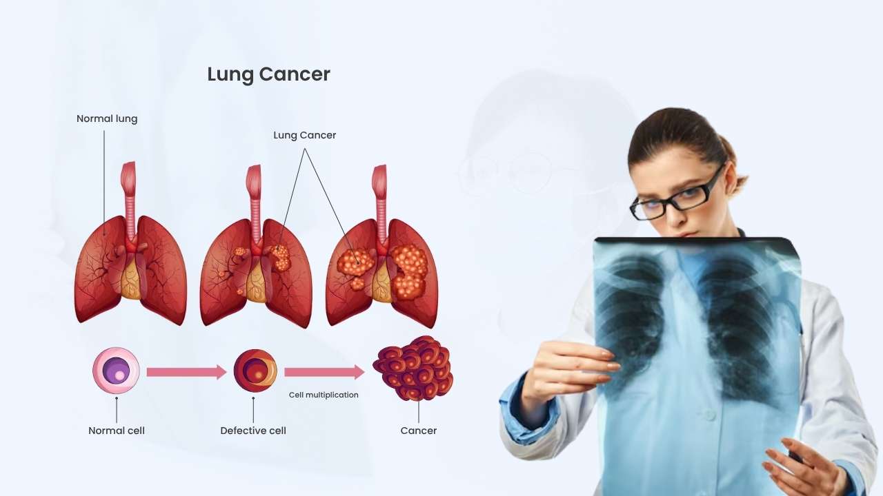 what is lung cancer surgery
