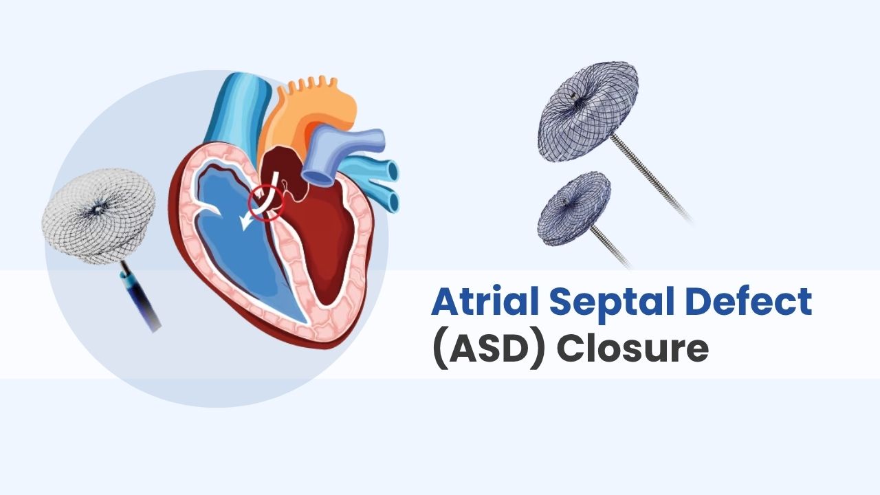 artial septal defect asd closure cost in india